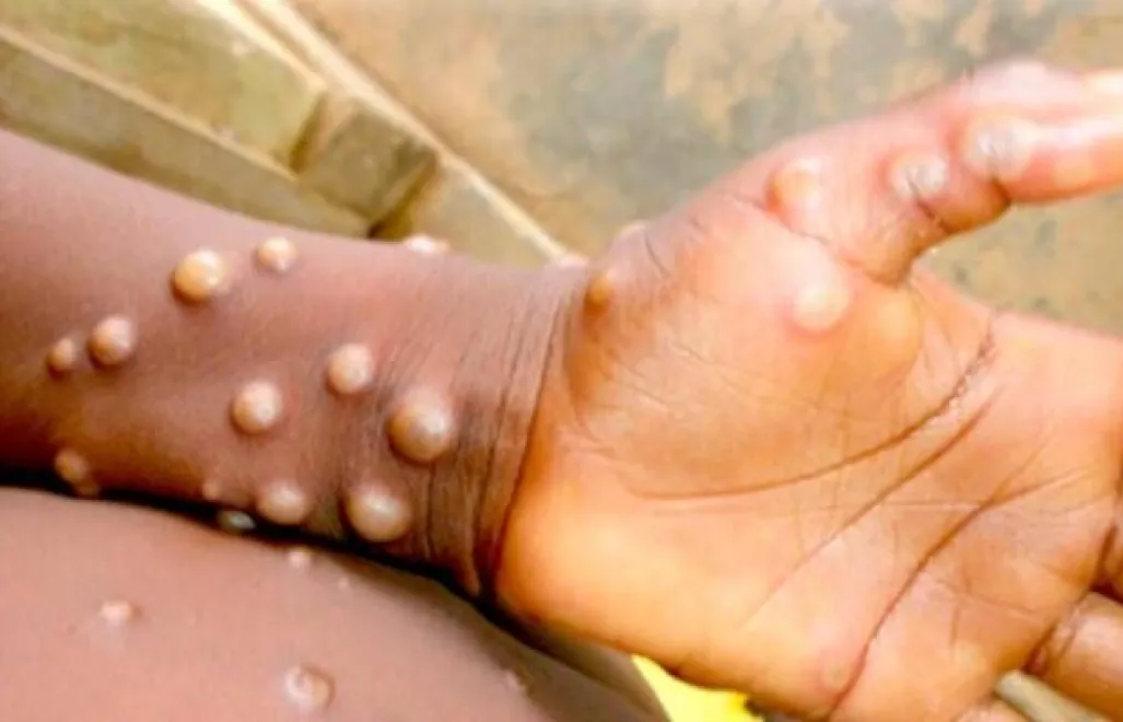 Małpia ospa. Fot. Twitter/astianmi