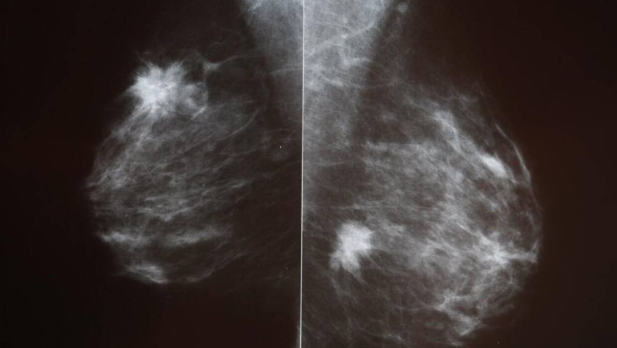 Białe jasne ogniska widoczne na prześwietleniu piersi, oznaczają zmiany o wysokim prawdopodobieństwie raka. Fot. PAP/Artur Reszko