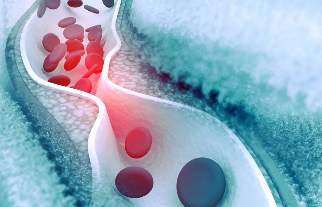 Terapia dziesięciokrotnie obniżyła poziom tzw. złego cholesterolu. Fot. Adobe Stock