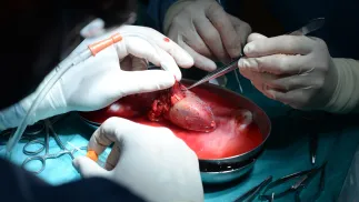 Nerka podczas operacji przeszczepu Fot. PAP/Jacek Turczyk