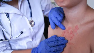 Pacjent chory na odrę Fot. AdobeStock