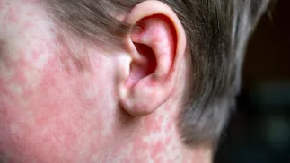 W 2024 r. odnotowano blisko 8-krotnie więcej zachorowań na odrę. Fot. Adobe Stock/Наталья Майшева