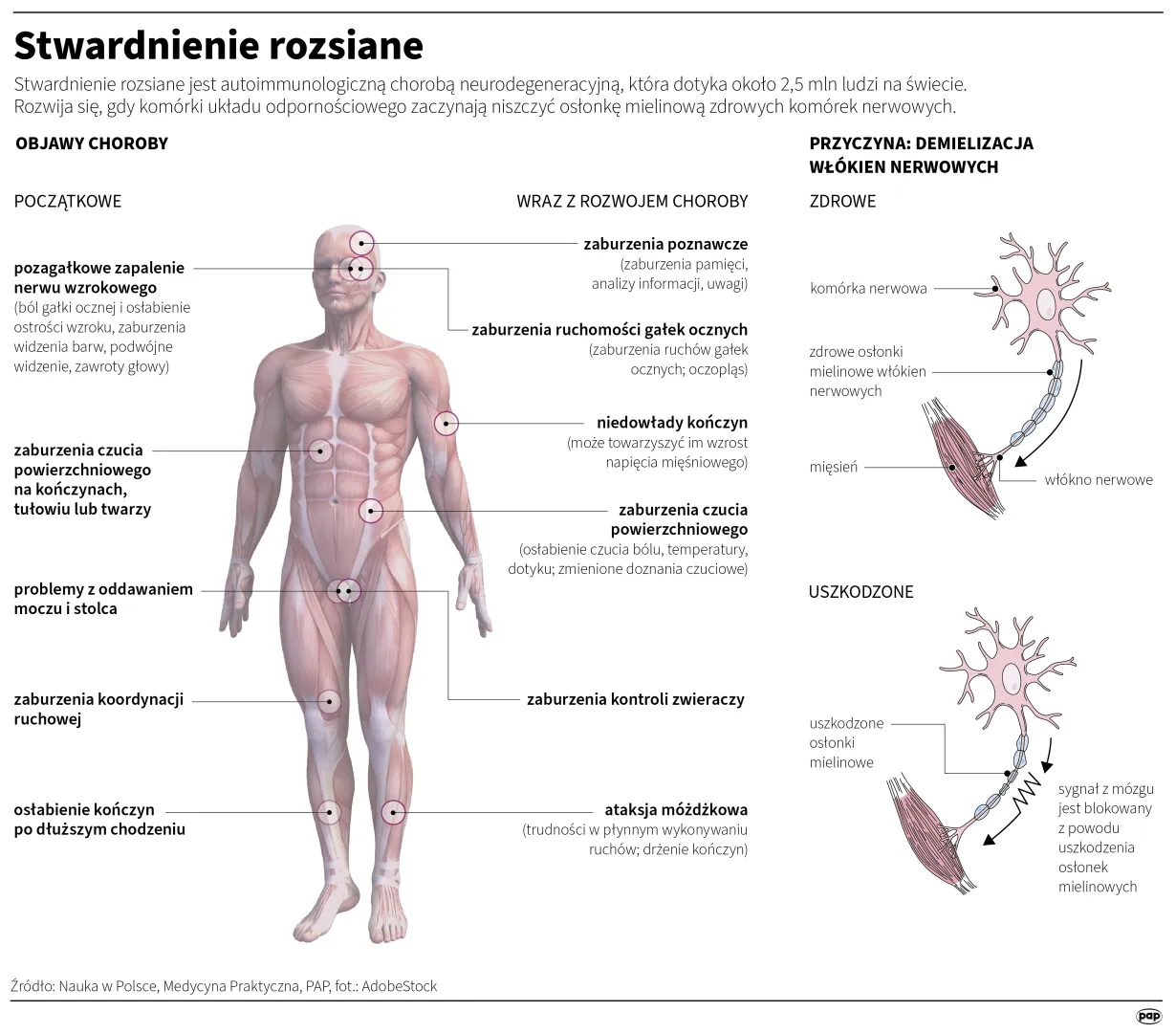 Stwardnienie rozsiane. Autor: PAP/Infografika/Maria Samczuk, Adam Ziemienowicz, Mateusz Krymski