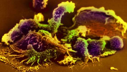 Komórki rakowe Fot. BSIP/Photoshot/PAP