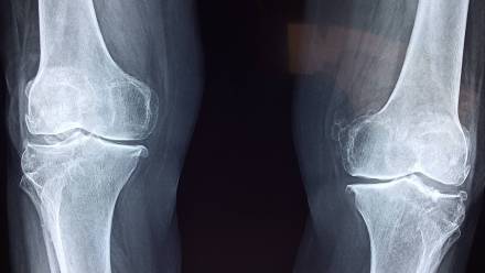 Kości nóg i kolana na zdjęciu RTG Fot. Pixabay/Taokinesis