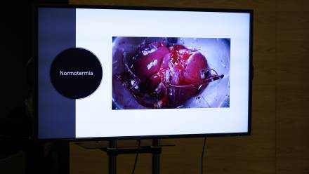 Materiały dot. przeszczepienia wspomagającego wątroby, fot. PAP/Albert Zawada